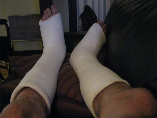 a pair of casts